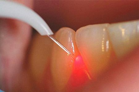 Лазер нового поколения в стоматологии